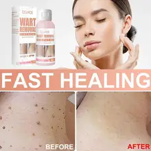 Effective Remove Flat Warts Cream Remove Melasma Acne Moisturizing Spots Care Skin Spot 30g Gel Melanin Dark D9e9