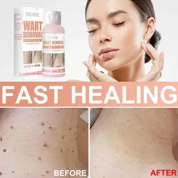 Effective Remove Flat Warts Cream Remove Melasma Acne Moisturizing Spots Care Skin Spot 30g Gel Melanin Dark D9e9