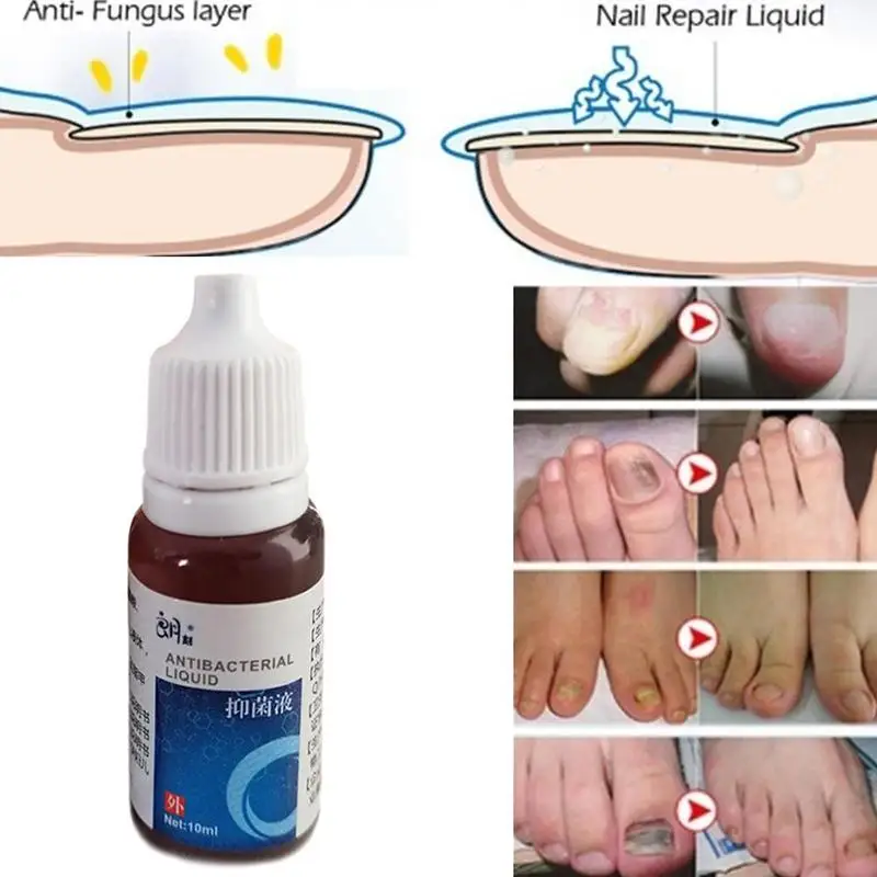 Эффективное средство для удаления грибка, масло для лечения Ногтей, увлажняющее средство для ухода за ногтями, восстанавливающая жидкость для ухода за ногтями, антибактериальная жидкость