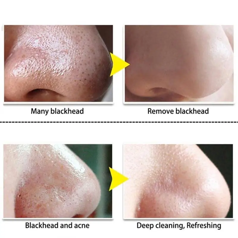 Blackhead Cream Nose Black Dots Mask Removal Black Remover Cream Face Burns Off Peel Care Skin Head Mask Damage X0L8