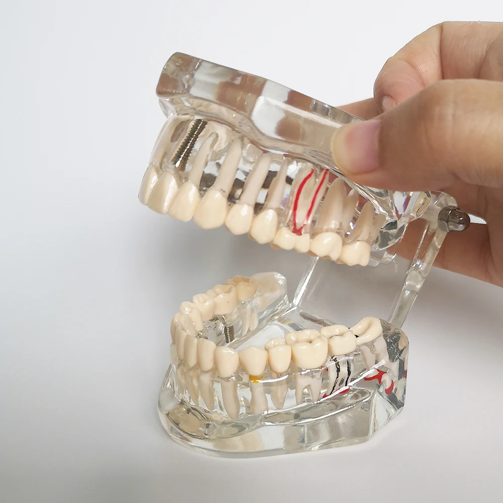 Nowy Model dentystyczny Implant zębów przywrócenie mostu nauczanie studium medycyna nauka choroba dentysta stomatologia produkty 5 Nowy Model dentystyczny Implant zębów przywrócenie mostu nauczanie studium medycyna nauka choroba dentysta stomatologia produkty 5