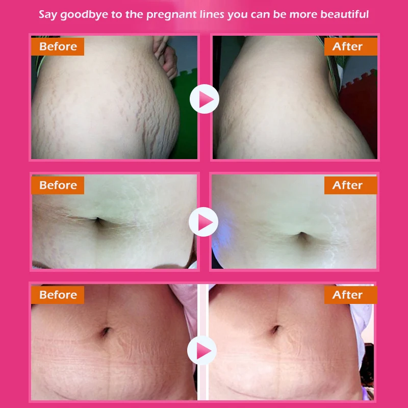 AFY удаление шрамов для беременности крем от акне растяжек лечение восстановление