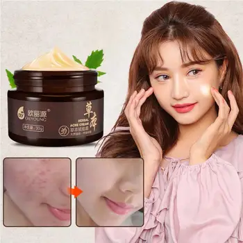 

OILYOUNG Natrual Herbal Acne Cream Anti Pimple Acne Scars Blackhead Removal Cream Oil control Face care cream Skin care TSLM2