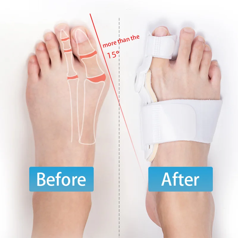 

Hot Sale Bunion Device Corrector Hallux Valgus Orthopedic Braces Big Toe Correction Feet Thumb Care Corrector Big Bone Orthotics