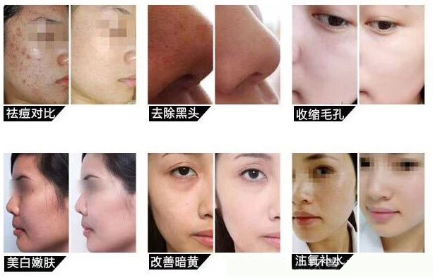 2018 new updated Face Rejuvenation skin lifting aqua facial machine skin care dermabrasion aqua machine peel