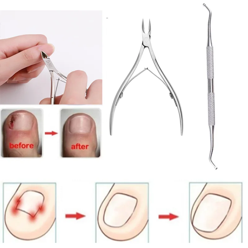 Onyx Professional Ingrown Toenail Kit with Toenail Clippers