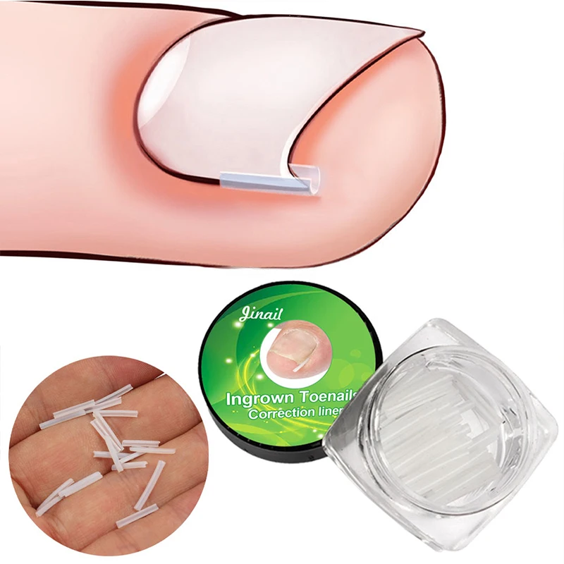 10pcs/box Ingrown Nail Pad Ortho Nail Filling Nail Groove Pad Ingrown