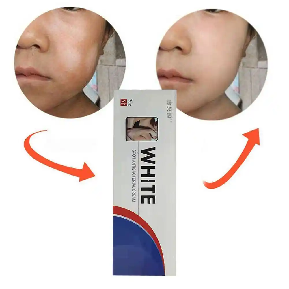 white patches ointment