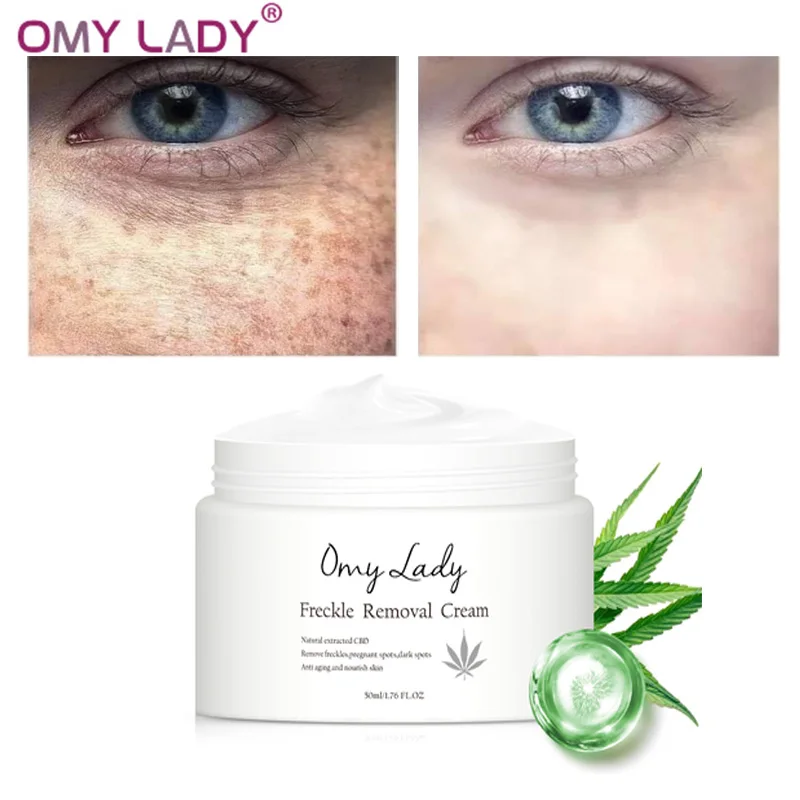 OMY LADY Freckle Removal Cream Remove 