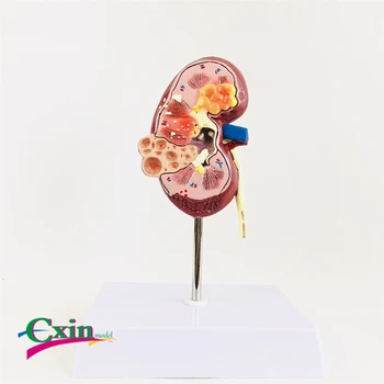 

Human kidney anatomical model disease kidney human organ anatomy medical teaching