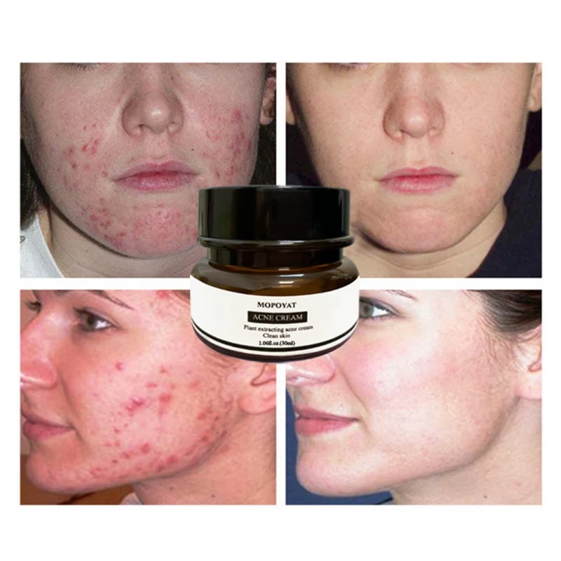 30g Acne Treatment Anti Acne Scar Removal Pimple Blackhead Moisturizing Whiten Oil control Shrink Pores Face 3