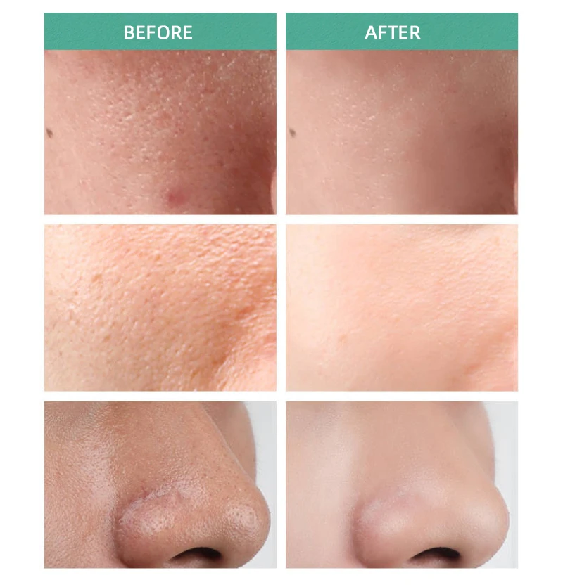 Astringent Before And After