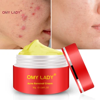 

OMY LADY Moisture Cream Skin Care Face Lift Essence Tender Anti-Aging Whitening Wrinkle Removal Face Cream Remove Acne Scar