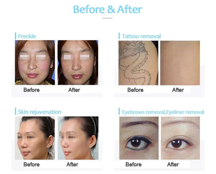 HONKON Q switched nd yag laser tattoo removal machine mv2008