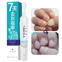 10 мл Лечение ногтей от грибка ручка эффективный онихомикоз Paronychia инфекция гель Уход за ногтями HJL2019