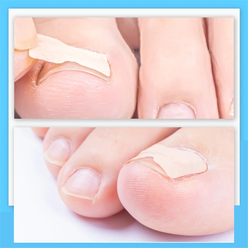 Ingrown Toenail Corrector Sticker Paronychia Treatment Fixer Recover Corrector Pedicure Foot Toe Nail Care Tool Elastic Patch