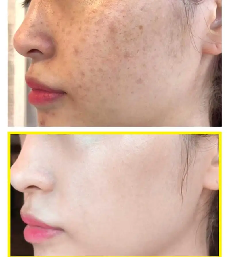 Some By Mi Yuja Niacin Blemish Care Serum 50ml Nicotinamide Whitening Essence Powerful Freckle Cream Remove Melasma Acne Spots Serum Aliexpress