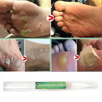 

3ml 3Days Skin Tag Remover Mole Remover Skin Tag Removal Skin Tag Removal Treatment Cream Face Care Mole Remover Wart Remover