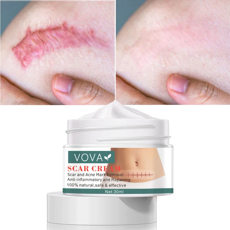 En venta 30g cicatriz de acné eliminación crema granos marcas Gel eliminar el acné suavizado blanqueamiento corporal hidratante cuidado de la piel 7WJoRqmR3R0