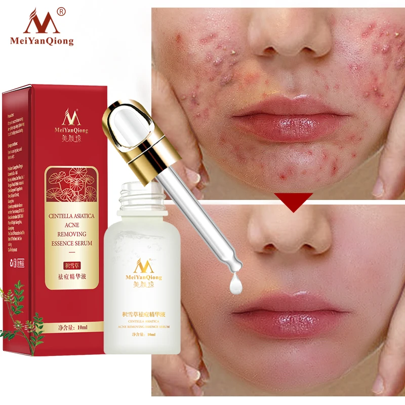 

Acne Treatment Face Serum Centella Asiatica Oil Control Shrink Pores Scar Essence Whitening Moisturizer Skin Care MeiYanQiong
