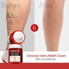 80g Varicose Veins Relief Cream Vasculitis Phlebitis Spider Pain Relief Ointment Body Care