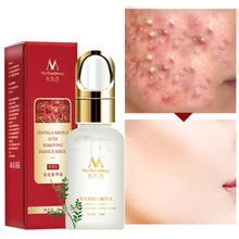 10 мл восстановление кожи средство для акне лечение шрамов анти-морщинки масло Управление натуральный ингредиент Универсальный Осветляющий Сыворотки увлажняющий