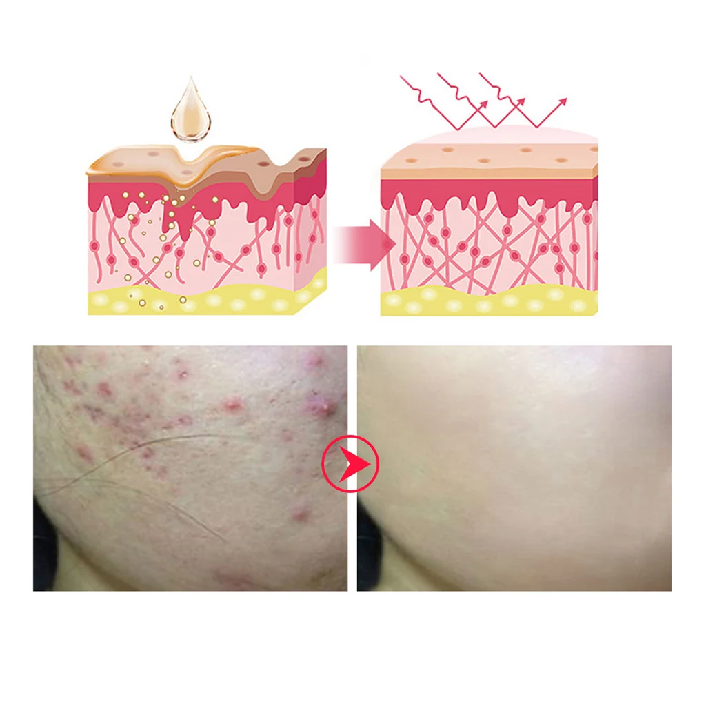 BREYLEE Acne Treatment Face Serum Mask Anti Acne Pimple Scar Remover Moisturizing Whitening Skin Care Facial Essence Cream