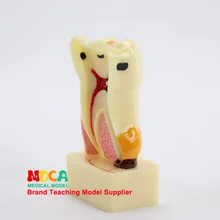 Анатомическая модель кариеса зубов. Зубная десневая шоу медицинская обучающая модель Myc009