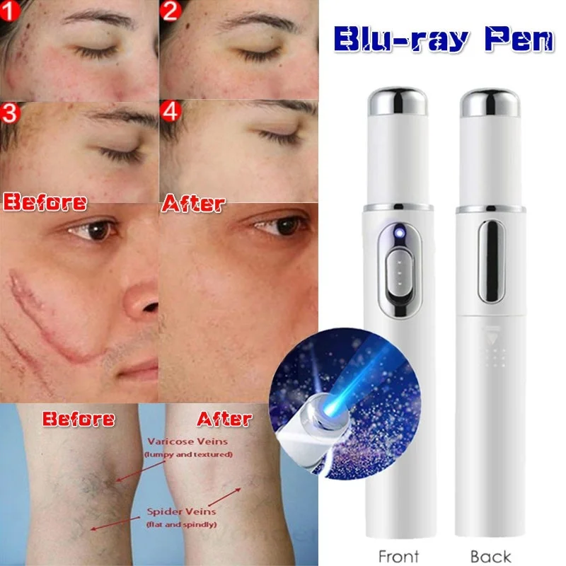 1pc Portable Medical Blue Light Therapy Acne Laser Pen Skin Spots Removal Anti Varicose Spider Vein Eraser Treatment | Красота и