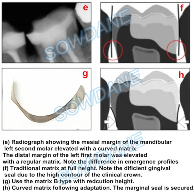 Dental-Tofflemire-Matrix-for-Deep-Margin-Elevation-Large-Curvature-Matrices-Retainer-Sectional-Contoured-Matrice-dental-Material (2)