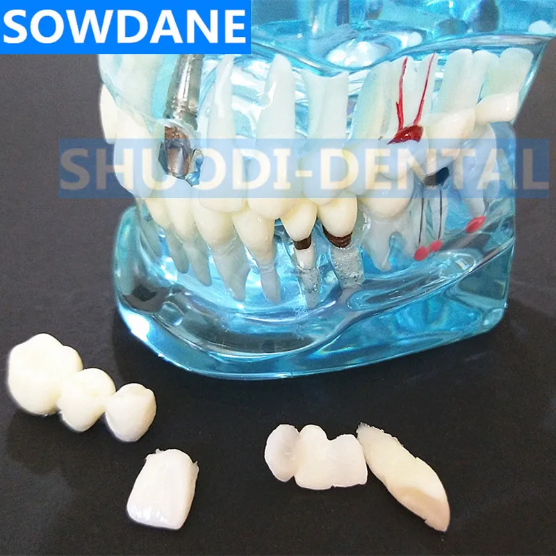 Горячая зубная имплантатная модель зубов с реставрацией мост палочки для очистки зубов для медицинских исследований Стоматологическое заболевание обучения, изучения