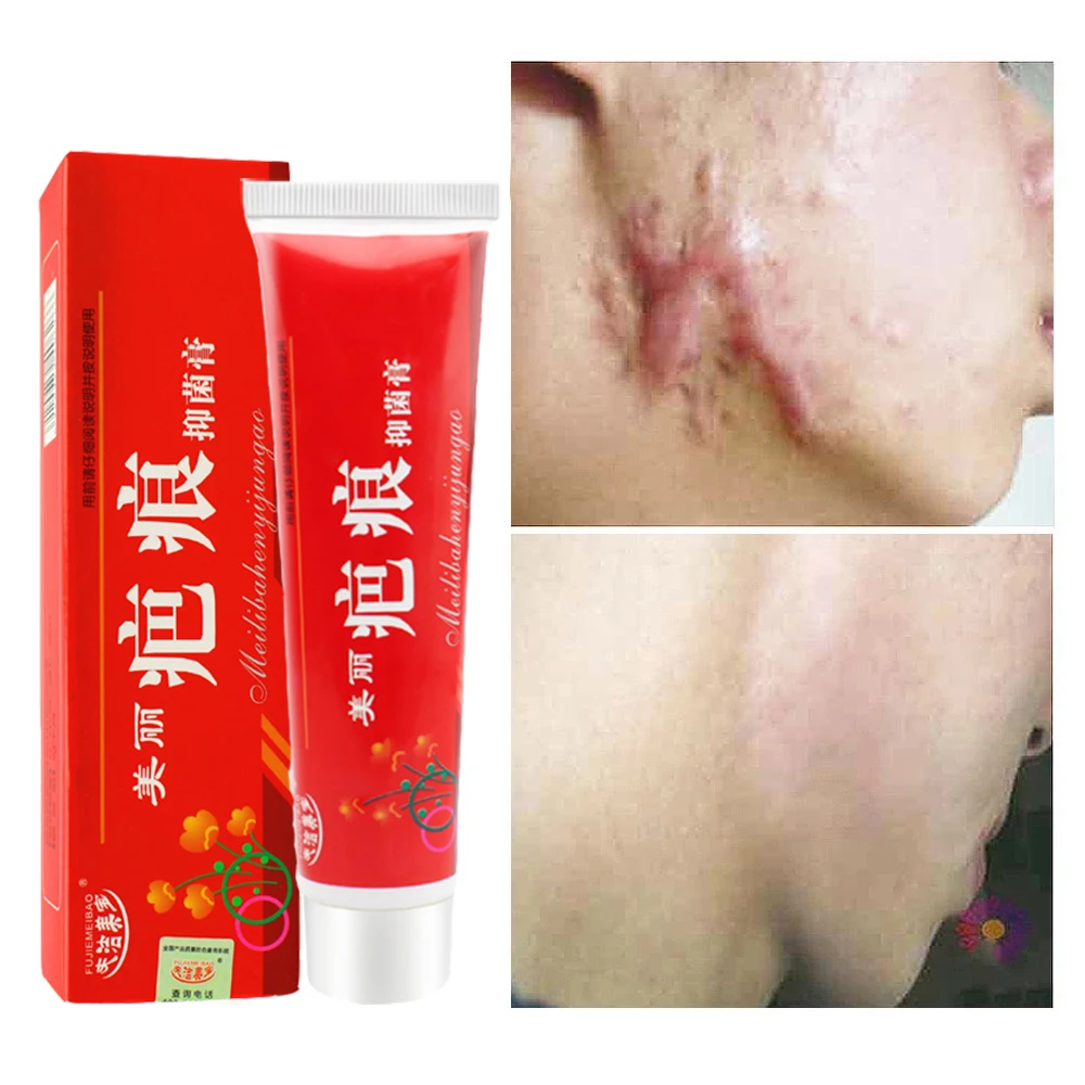 Cicatriz de acné eliminación crema granos marcas Gel eliminar el acné suavizado blanqueamiento corporal hidratante cuidado de la piel