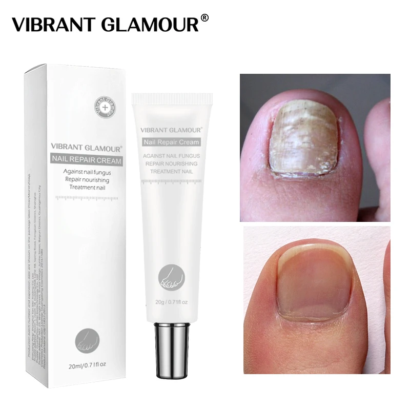 

VIBRANT GLAMOUR Nail Fungus Treatment Cream Nail Care Anti Fungal Nail Infection Cuticle Remover Liquid Nail Growth Skin Care