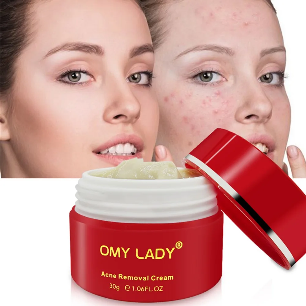 

Anti-Acne Cream Moisturizing Oil-Control Shrinking Pores Smoothing Skin Acne Treatment Cream