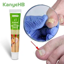 

1pcs Nail Fungal Treatment Cream Feet Nail Care Cream Toe Nail Whitening Fungus Paronychia Onychomycosis Removal Ointment G004