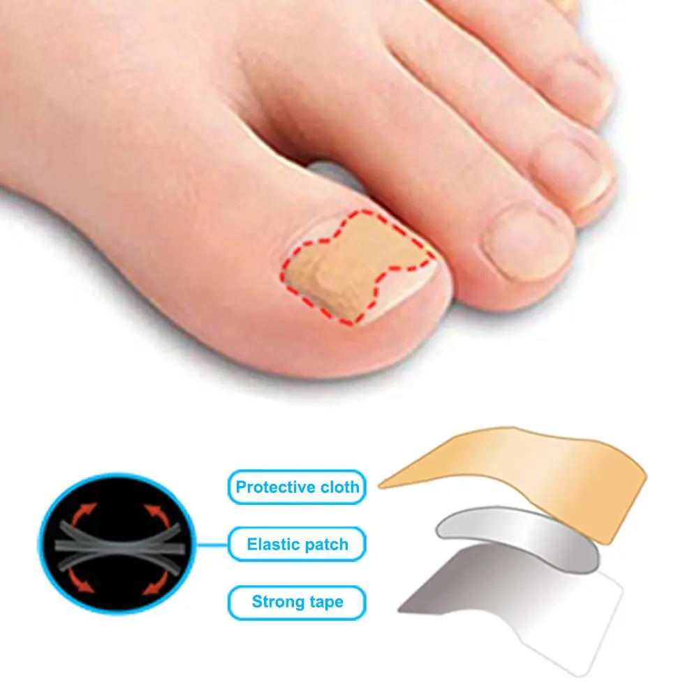36/72PCS Ingrown Toenails Correction Patch Physical Straightening Elastic Toenail Pedicure Stickers Brace Bunion Corrector