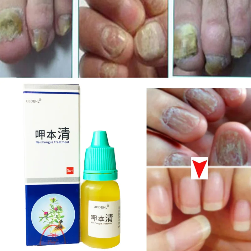 Лечение ногтей Onychomycosis Paronychia противогрибковые инфекция хороший результат