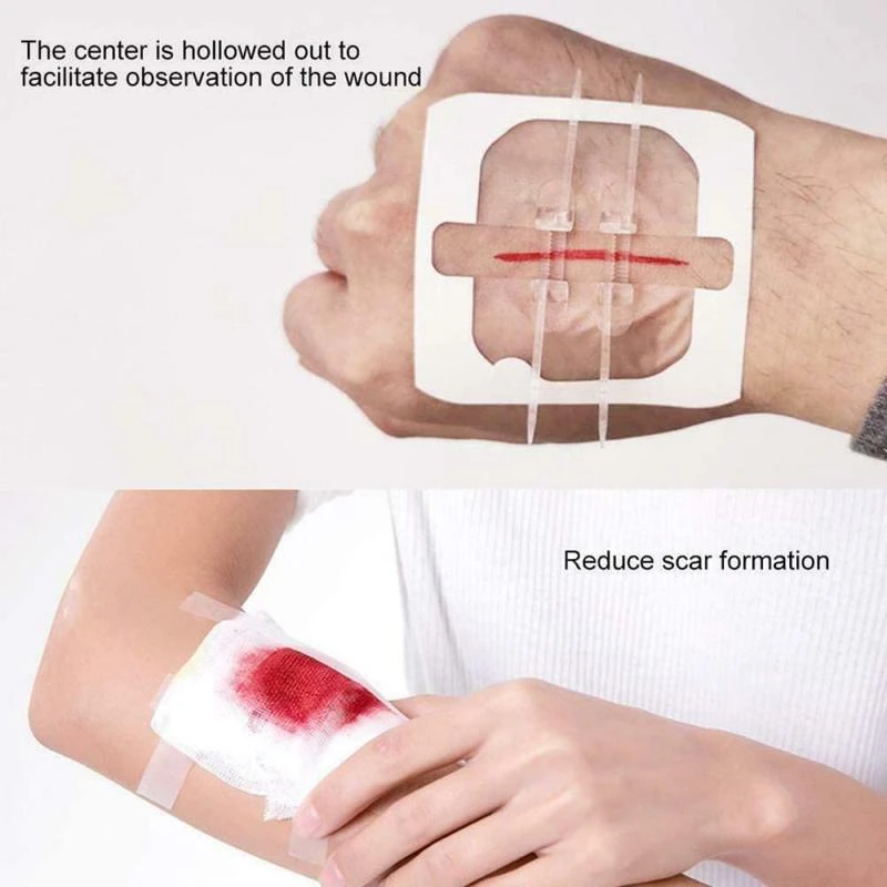 Zip Suture Reducer Band Aid Zippered Wound Painless Suture Adhesive Wound  Closure Band Aid Wound Closure Device Outdoor Tools - AliExpress Sports \u0026  Entertainment