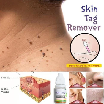 

Skin Tag Remover 12 Hours Tu Kill Medical Tu Kill Remover Skin Tag Mole Genital Wart Remover Foot Corn Blackhead Remover 10ml