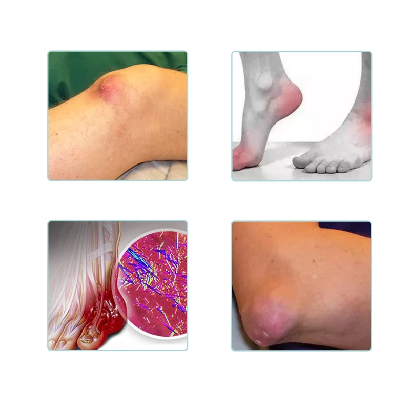 40 pcs/2 Packs Blood Uric Acid Balance Tea for Joint pain edema inflammation Gout Treatment Reduce fat pure natural herbs Tea