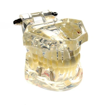 

Implant Disease Teeth Model with Restoration Bridge Tooth Dentist for Science Disease Teaching Model