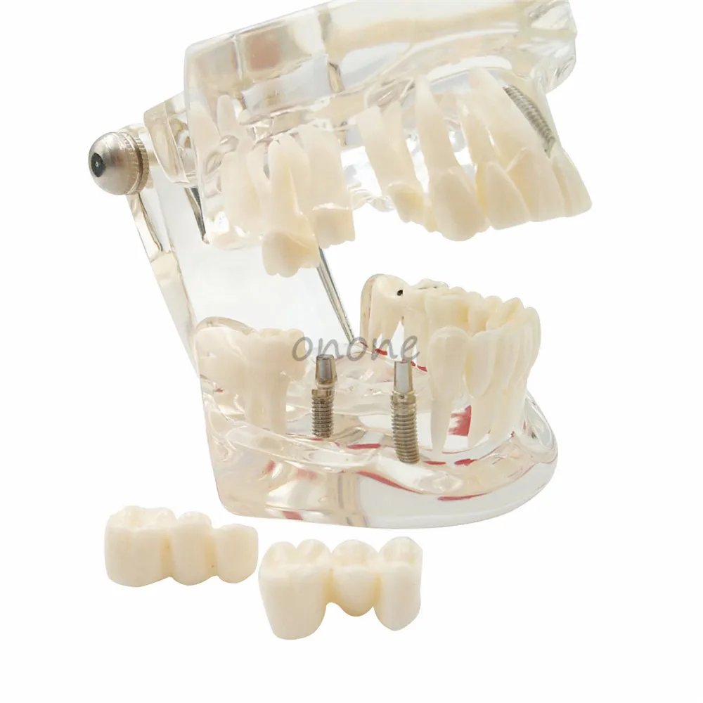 

1 Pcs Dental Model Teeth Implant Restoration Bridge Teaching Study Tooth Medical Science Disease Dentist Dentistry Products