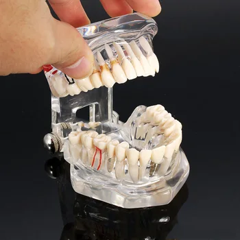 

Dental Implant Disease Teeth Model with Restoration Bridge Tooth Dentist for Medical Science Dental Disease Teaching Study
