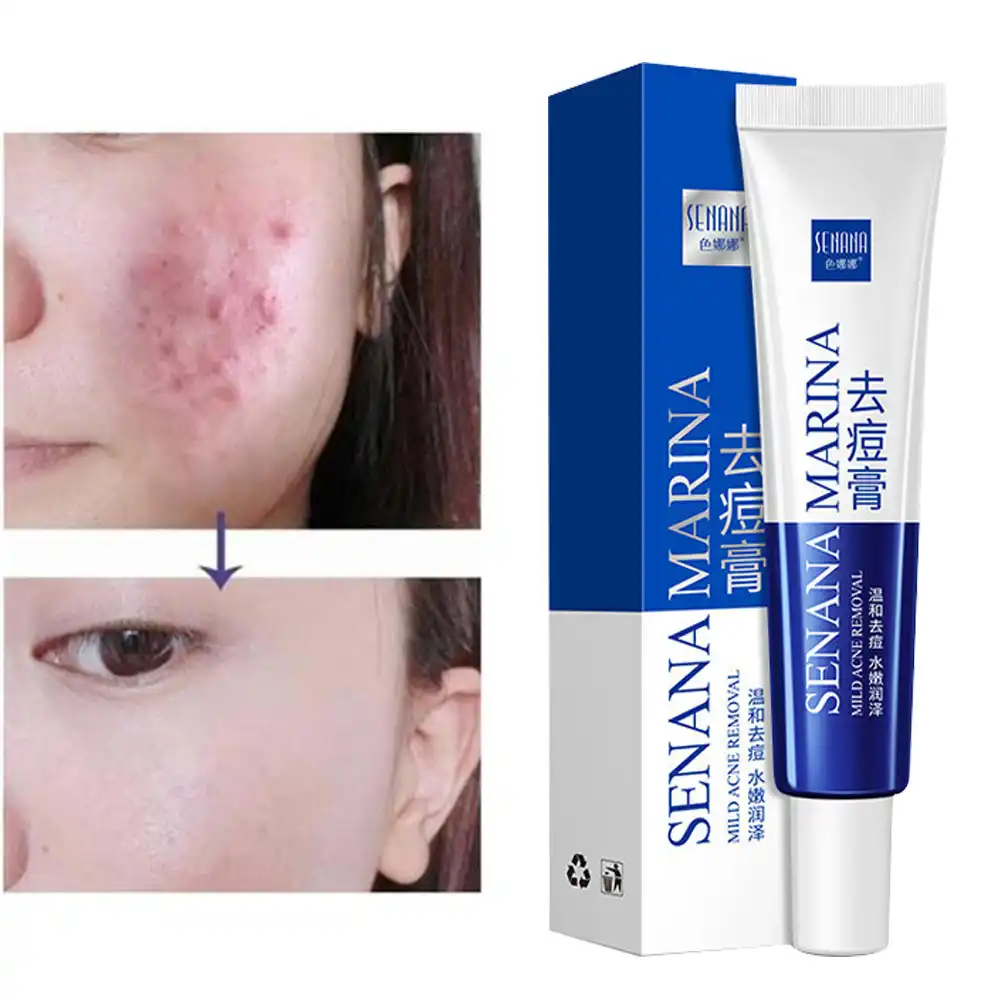 anti inflammatory acne products