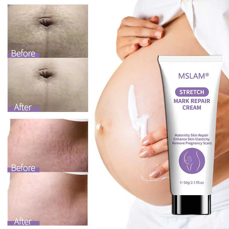 Maternity Stretch Mark Prevention Cream-Paraben-Free Hypoallergenic Safe for Pregnancy-Dermatologists Recommend 50g stretch marks cream