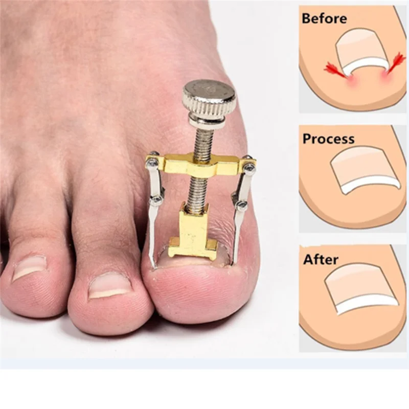 Ingrown Toe Nail Recover Correction Pedicure Toenail Fixer Orthotic Nail Corrector Foot Care Tool