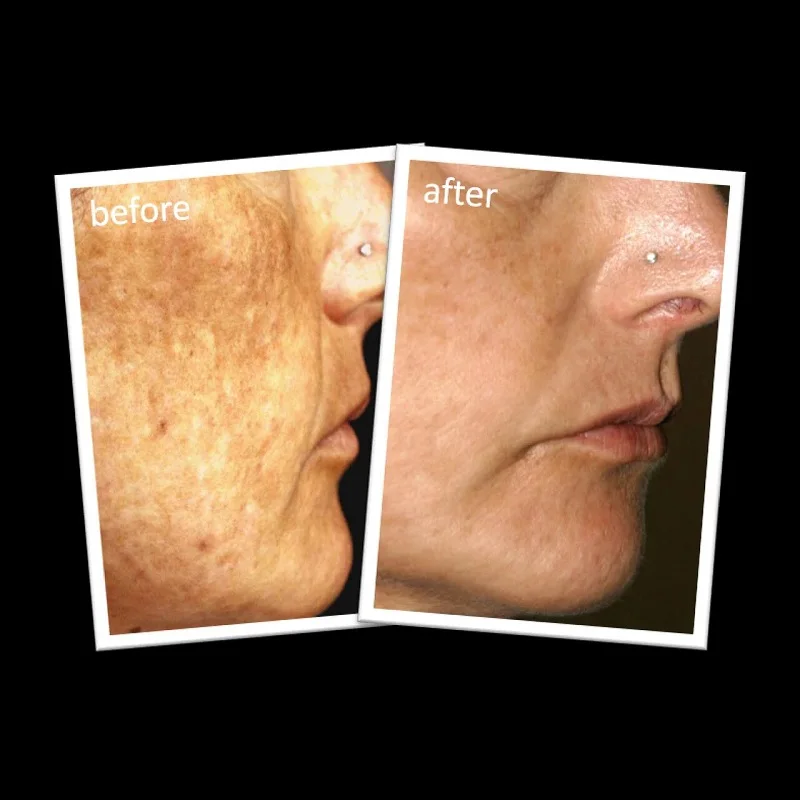 Superfade Fading Face Cream for Dark Hormone Marks Age Spot  (0)