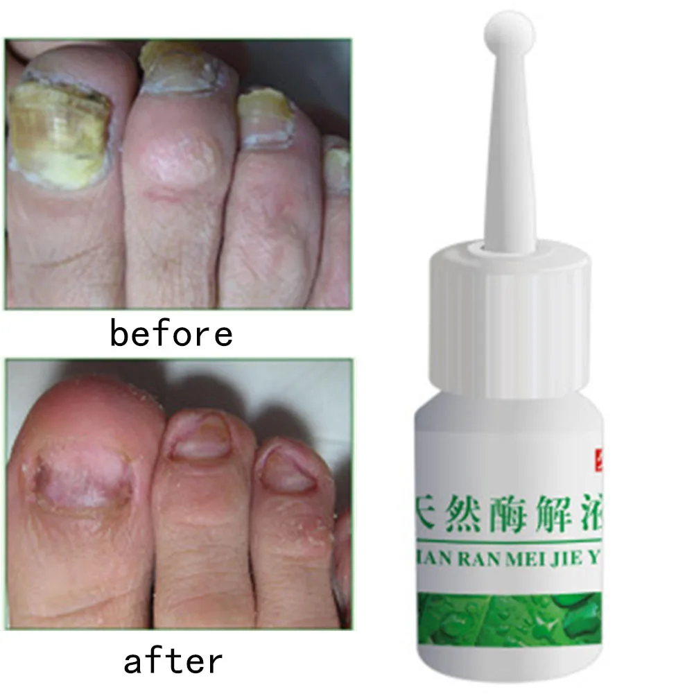 Onychomycosis удобное портативное безболезненное удаление ногтей энзиммолиз жидкость Leuconychia жидкость Ringworm эфирное масло Leuconychia