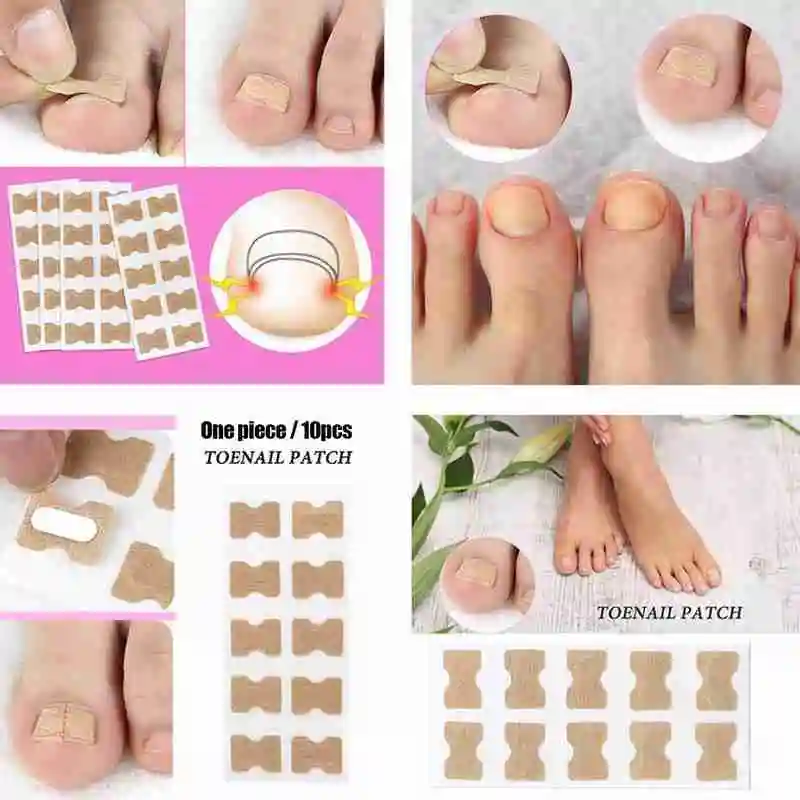 10pcs Ingrown Toenail Corrector Stickers Fingernail Toe Nail Corrector Patch Paronychia Inlays Treatment Care Pedicure Tools Hot