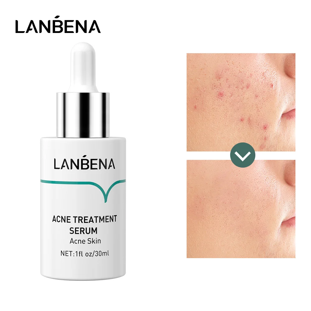 

LANBENA Anti Acne Serum Shrink Pores Deep Repair Solution Strengthen Skin Bottom Liquid Acne TREATMENT Oil-control SERUM30ML